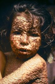 1200px-Child_with_Smallpox_Bangladesh